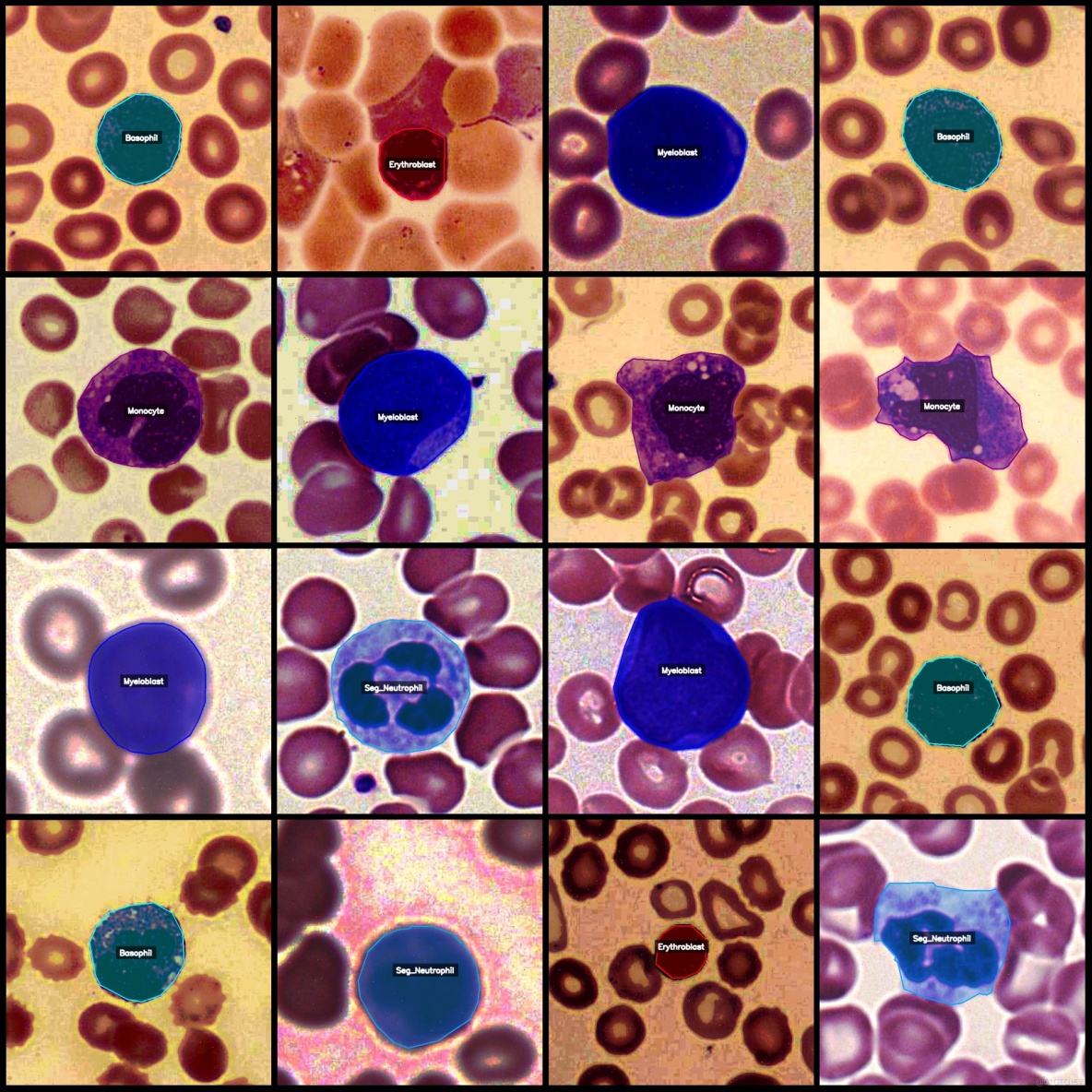 癌症檢測血細胞識別分割數據集labelme格式4918張5類別_json數據_04