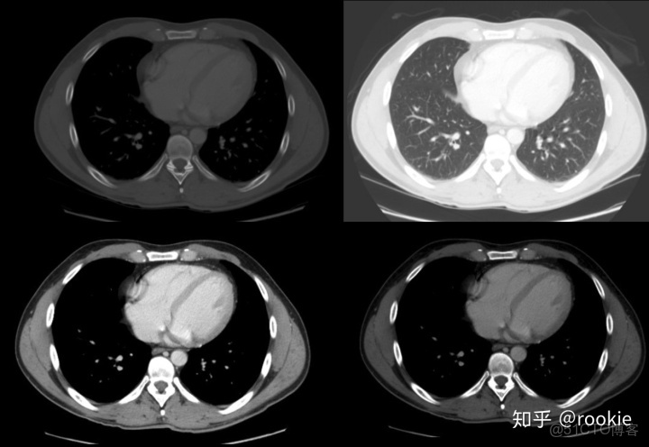 CLAHE算法增強局部對比度的X光圖像增強效果對比_ico_02
