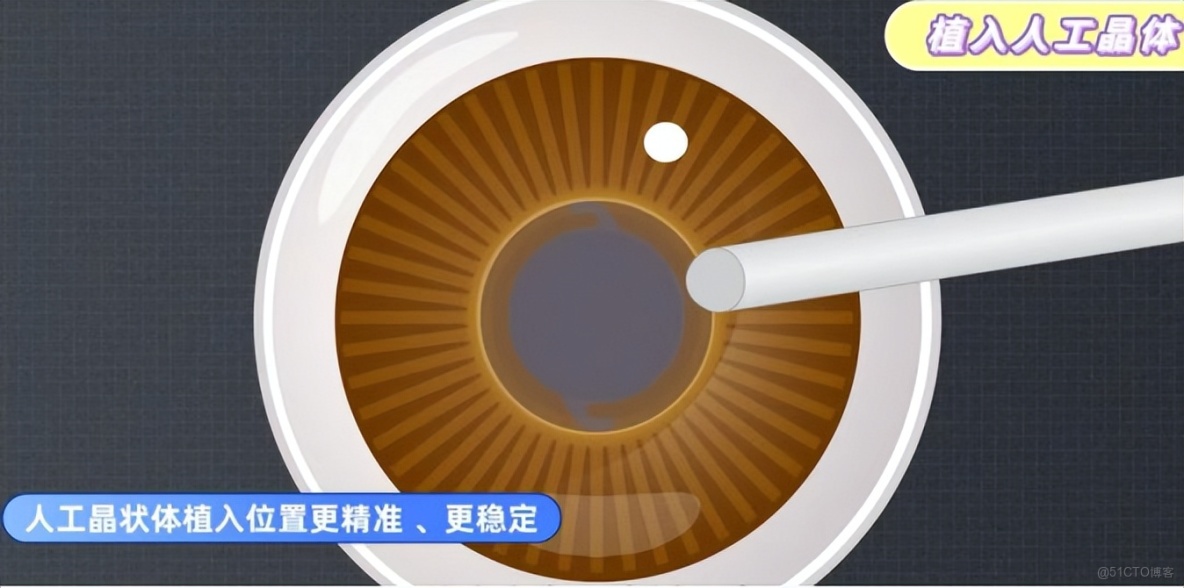 飛秒激光輔助白內障手術，北京愛爾英智眼科醫院丁雪為您解讀_機械臂_03