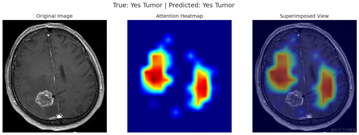 深度學習實戰-基於Vision Transformer的腦腫瘤MRI圖像識別_#人工智能_15