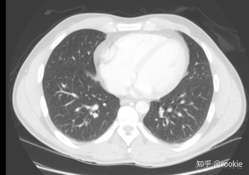 CLAHE算法增強局部對比度的X光圖像增強效果對比_#python 計算對比度_10
