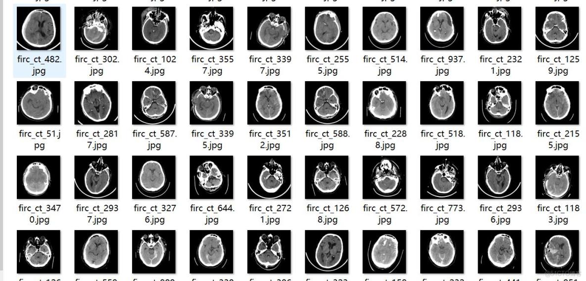 CT圖像腦出血診斷檢測數據集VOC+YOLO格式3568張4類別_xml文件_02