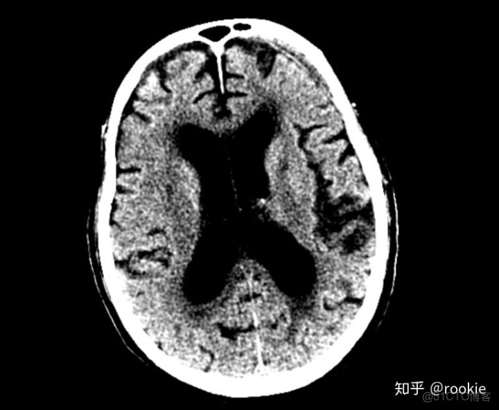 CLAHE算法增強局部對比度的X光圖像增強效果對比_f5_16