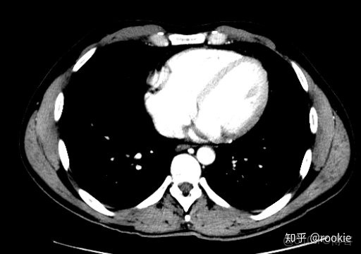 CLAHE算法增強局部對比度的X光圖像增強效果對比_ico_12