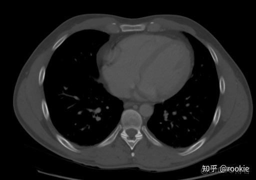 CLAHE算法增強局部對比度的X光圖像增強效果對比_3D_09