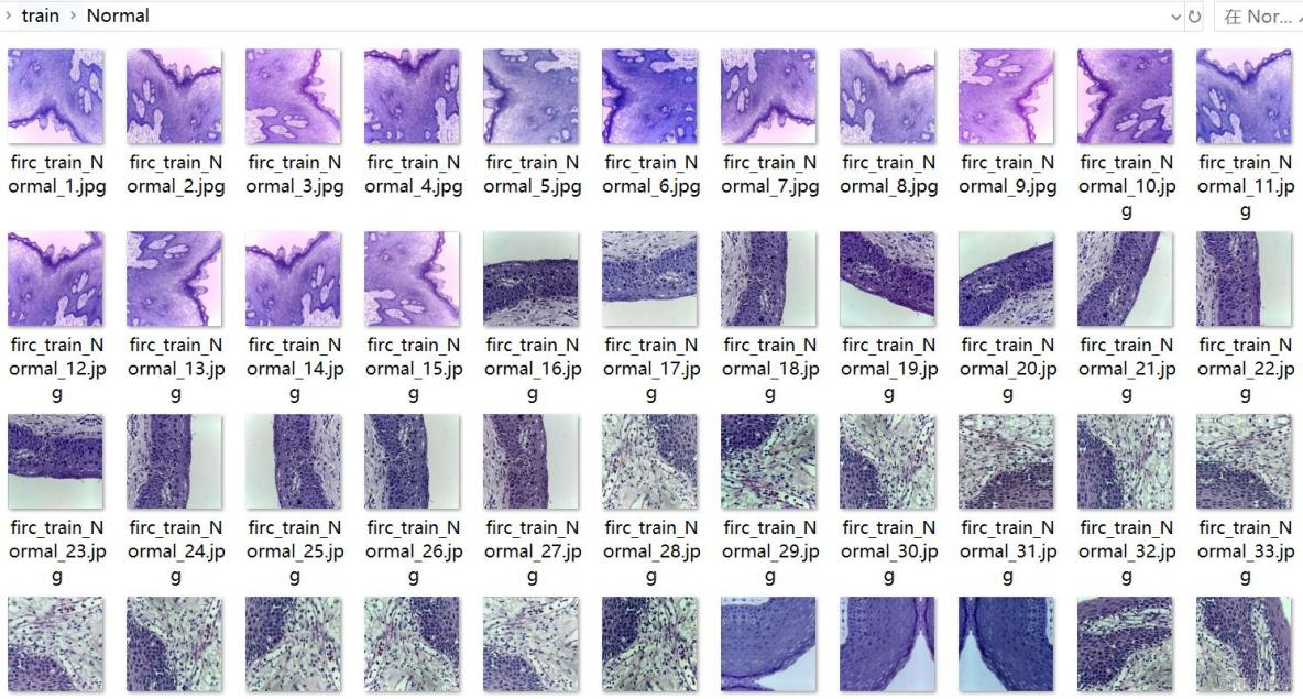 口腔癌病理染色組織切片圖片分類數據集11303張2類別_圖像分類