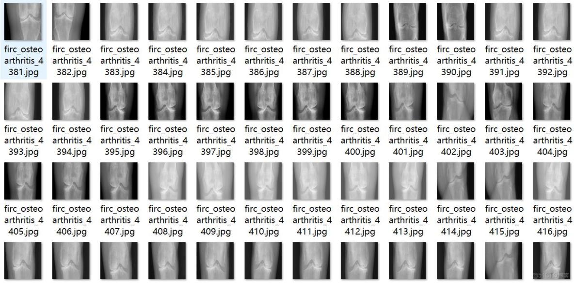 智慧醫療膝蓋骨關節炎嚴重程度檢測數據集VOC+YOLO格式8000張5類別_數據集_02