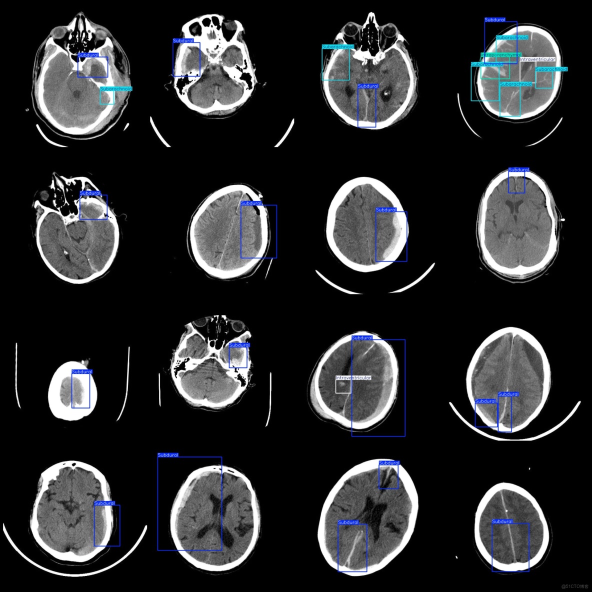 CT圖像腦出血診斷檢測數據集VOC+YOLO格式3568張4類別_txt文件_03