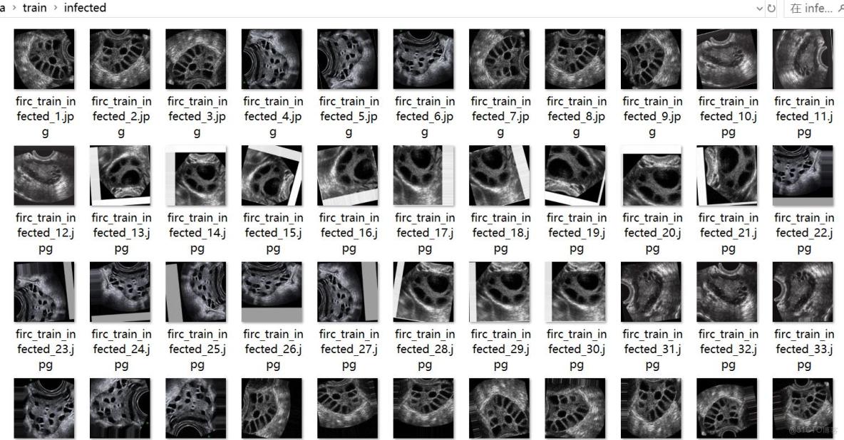 超聲圖像多囊卵巢綜合症分類數據集4637張2類別_圖像分類
