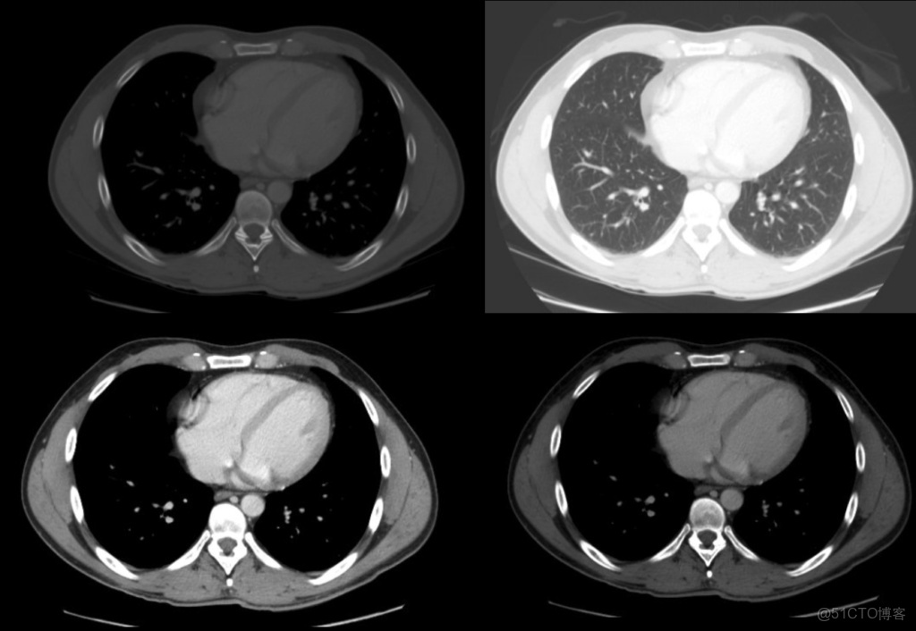 CLAHE算法增強局部對比度的X光圖像增強效果對比_3D