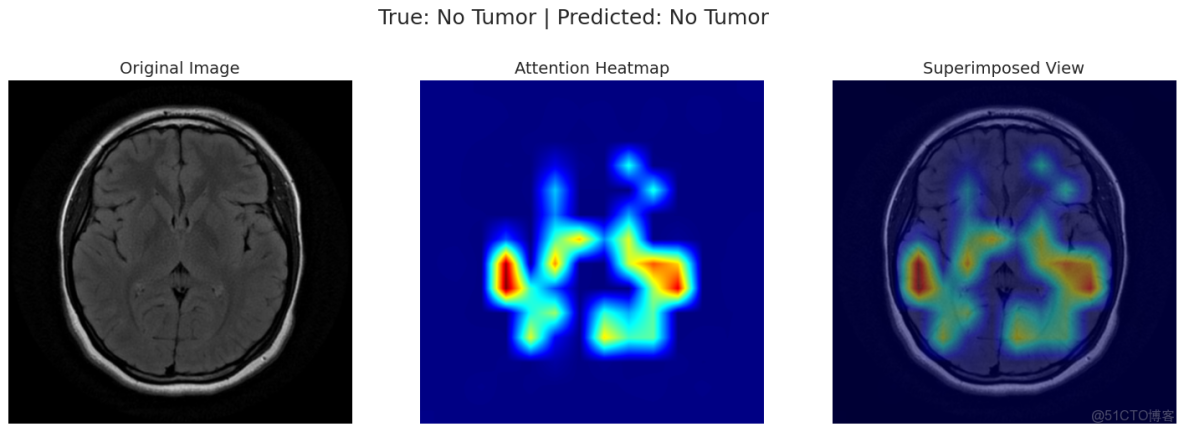 深度學習實戰-基於Vision Transformer的腦腫瘤MRI圖像識別_Image_16