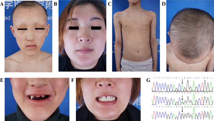 遺傳病、罕見病、腫瘤、家系最新文獻目錄 2025/04/19~11/25 全96篇_Pan_02