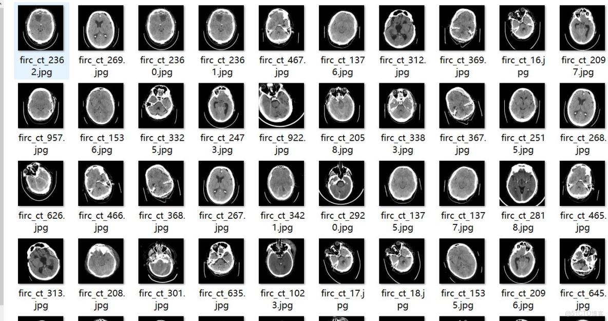 CT圖像腦出血診斷檢測數據集VOC+YOLO格式3568張4類別_txt文件