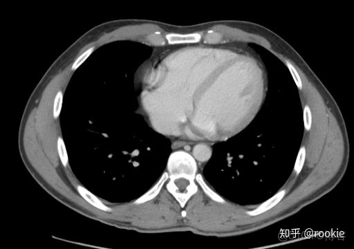 CLAHE算法增強局部對比度的X光圖像增強效果對比_#python 計算對比度_13
